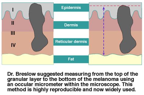 how to measure breslow thickness|breslow thickness definition.